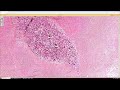 Gelfoam in a dermatofibroma (pathology dermpath dermatology dermatopathology)