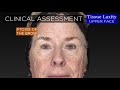 69 yo Female Total Facial Rejuvenation - An Amazing Transformation | Aesthetic Minutes #Facelift