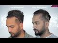 Unlocking Celebrity Hair Transplant Secrets: Elvish Yadav's Eugenix Experience