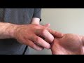 Scaphoid Fracture Test (Clinical Exam) and the Anatomic Snuffbox