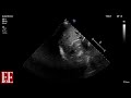 Foundations of Echocardiography: BSE Level 1 Focused Scan