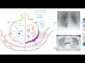 Acute Respiratory Distress Syndrome | Causes | Pathogenesis | Treatment | Harrison