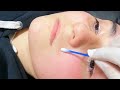 🔴 ACNE con PEELING QUÍMICO | Demostración con ÁCIDO SALICÍLICO Y Glicólico | microdermoabrasión