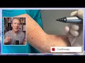 That's not a mole! Uncovering the Mystery of Seborrheic Keratosis