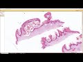 Malignant Epidermal Lesions & Mimics 101 (Carcinoma Basics - Dermatopathology Dermatology Pathology)