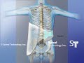 Left Lumbar Curve Scoliosis Providence Nocturnal Scoliosis® System