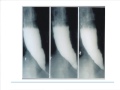 Esophageal Motility Disorders