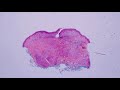 Cellular Neurothekeoma vs Nerve Sheath Myxoma - Dermpath Lookalikes