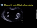 3D scan at 12 weeks: fetal body and legs
