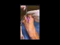 Severe Crossover Claw Toe Surgically Treated with Amputation
