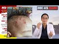 HOME TREATMENT sa TIGDAS-HANGIN ( Roseola Infantum) || Doc-A Pediatrician