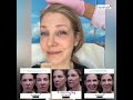 Under Eye Filler reversal &  Ultraclear Lasercoring