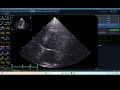 IQ 218 AUTOEF CHOCARDIOGRAPHY ECHOPAC ANALYSIS MEASUREMENT