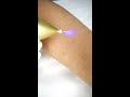 PLASMA PEN