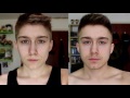 1 YEAR ON T: FTM TRANSGENDER