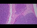 Spiradenoma & Cylindroma...Sweat Gland Tumor Pathology