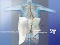 Left Thoracolumbar Curve Scoliosis Providence Nocturnal Scoliosis® System