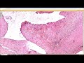 Ganglion cyst under the microscope (synovial cyst; Baker's cyst) pathology dermpath dermatology