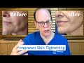 Should You Get Microneedling or Laser Resurfacing? | Plastic Surgeon's Advice