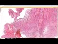 Deep Granuloma Annulare vs Rheumatoid Nodule (palisaded necrobiotic granuloma) pathology dermpath