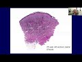 Accurate Histologic Diagnosis of Melanoma