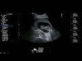 14 weeks ultrasound