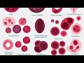 Types of anemia