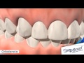 Corrección de mordida y espacios dentales 