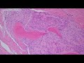 Ossifying Fibromyxoid Tumor (OFMT) of Soft Parts