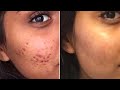 Oriflame || Pure Skin SOS Blemish Gel | For Acne & Pimples | Acne Treatment | new nurhain channel