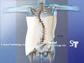 Double Curve Scoliosis Providence Nocturnal Scoliosis® System