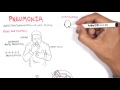 Pneumonia Overview