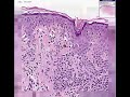 Histopathology Skin--Compound Clarks nevus (dysplastic nevus