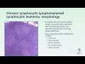 Bread and Butter  Hematopathology: Small B-Cell Lymphoma