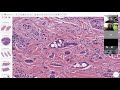 Microcystic Adnexal Carcinoma vs Desmoplastic Trichoepithelioma (Paisley Tie/Tadpole Pattern)