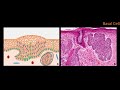 Introduction to NMSC Skin Cancer #2: Basal Cell Cancer (BCC) and Squamous Cell Cancer (SCC)