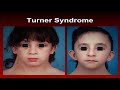 Dentistry and Orthodontics in Turner Syndrome