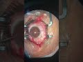 Retiro de lente intraocular por error de cálculo “twist technique”