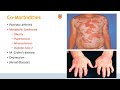 Treating Severe Psoriasis in Adult Patients | Menno de Rie, MD, PhD | Netherlands