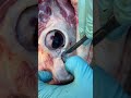 Proper caping / Releasing eye & tear duct/ ( Segment 6)