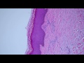 Basic Dermpath Cases  - Explained by a Dermatopathologist