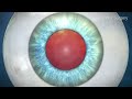 Cataract Surgery Animation