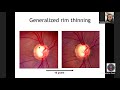 iFocus Online Session #99,  Glaucoma #3: Optic Disc Evaluation