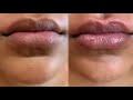 MicroNeedling Hyaluronic Acid Lip Filler