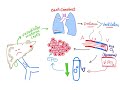 Hepatopulmonary syndrome