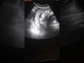 Fetal Death 32 weeks