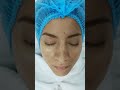 DR PEN EN CONTORNO DE OJOS HIDRATACION Y RENOVACION CELULAR