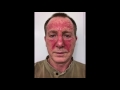 Actinic Keratosis Fluorouracil Treatment 27-Day Time Lapse