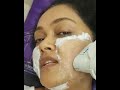 Ultherapy by Dr Rashmi Shetty - Procedure