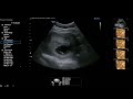 13 week 3D ultrasound